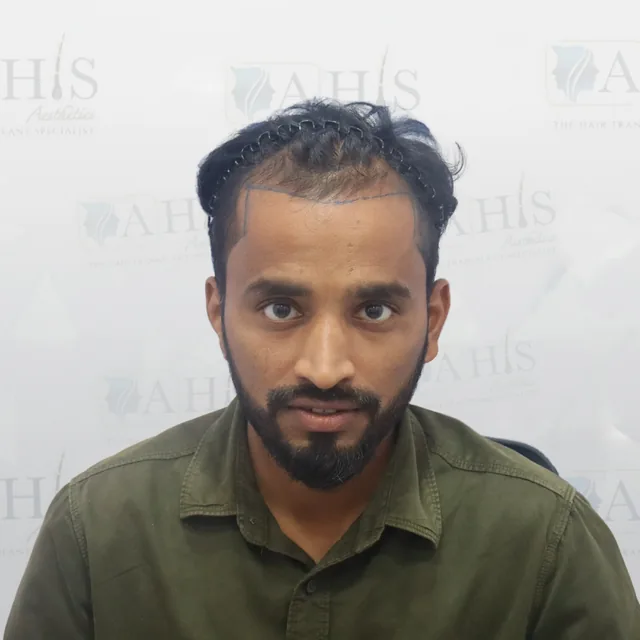 Frontal Hairline Restoration — before hair transplant at AHIS Aesthetics Mysore