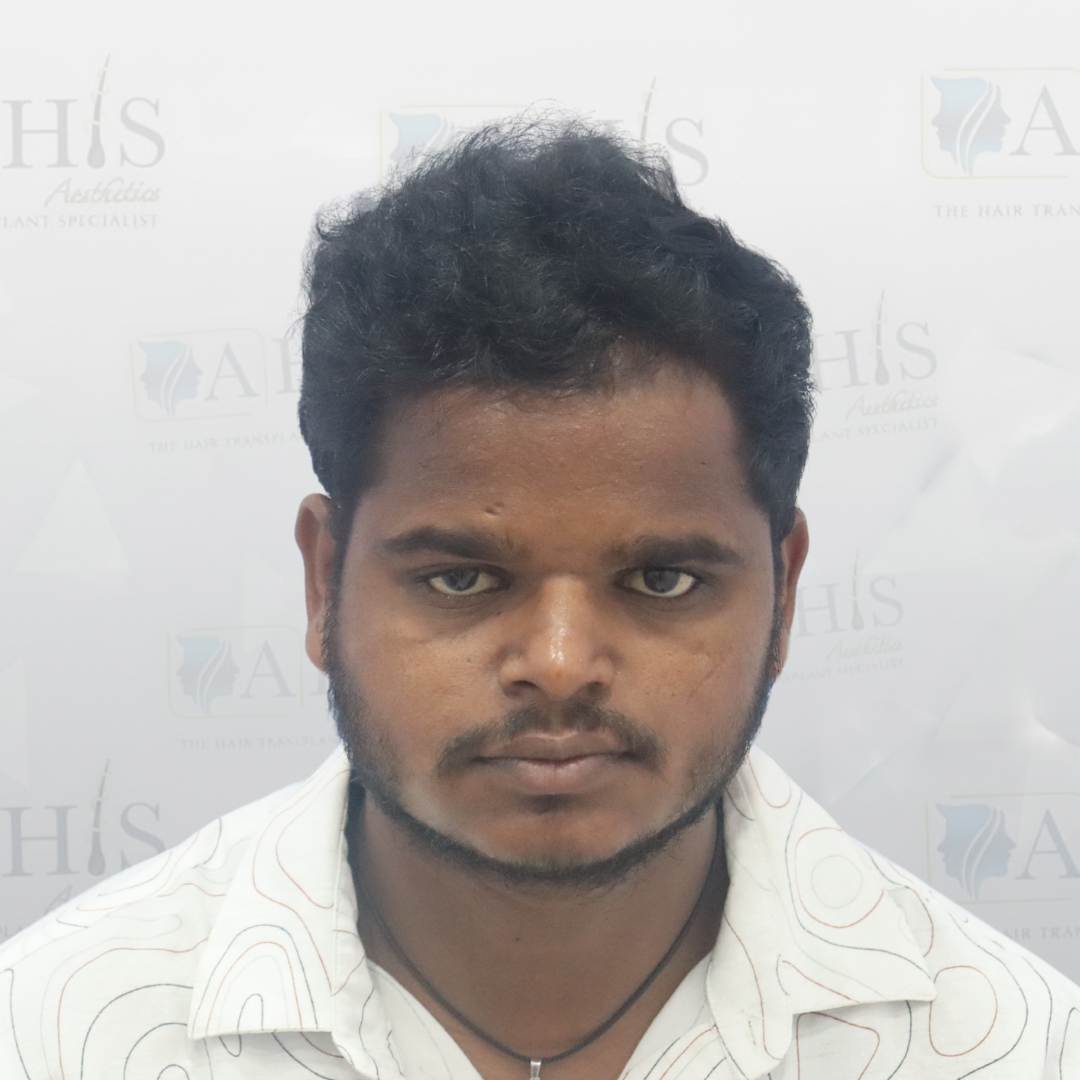 Advanced Frontal Hair Restoration — after hair transplant at AHIS Aesthetics Mysore