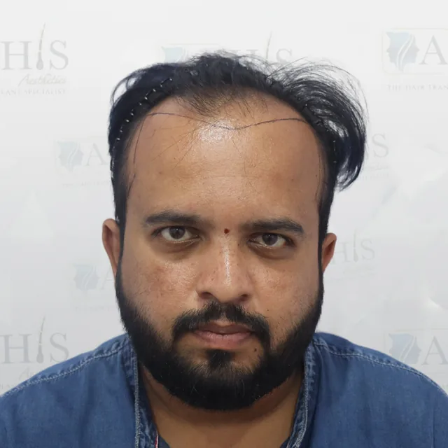 Frontal Hairline & Temple Restoration — before hair transplant at AHIS Aesthetics Mysore