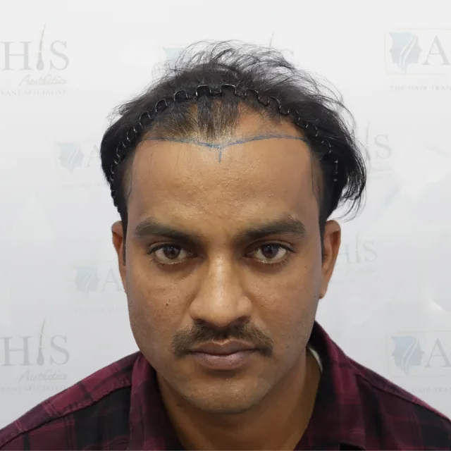 Hairline Reconstruction & Density — before hair transplant at AHIS Aesthetics Mysore
