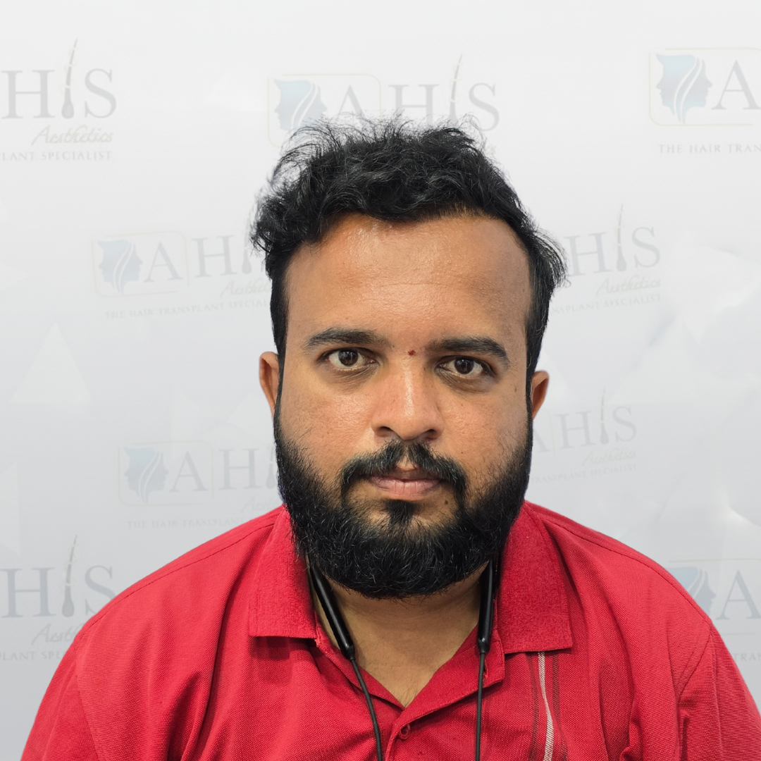 Frontal Hairline & Temple Restoration — after hair transplant at AHIS Aesthetics Mysore
