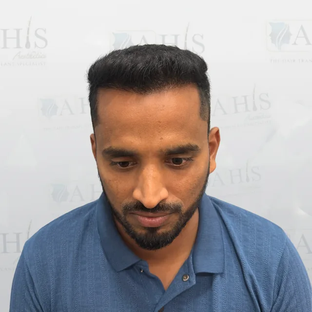 Frontal Hairline Restoration — after hair transplant at AHIS Aesthetics Mysore