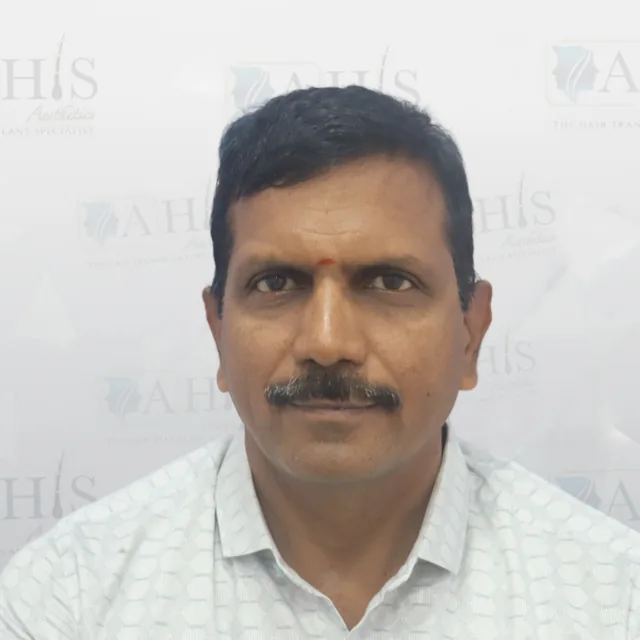 Frontal Hairline & Density Improvement — after hair transplant at AHIS Aesthetics Mysore