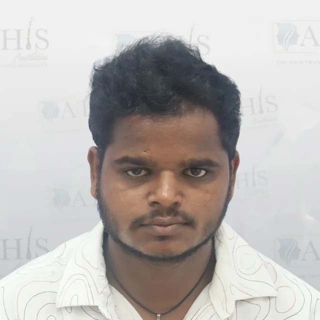 Advanced Frontal Hair Restoration — after hair transplant at AHIS Aesthetics Mysore