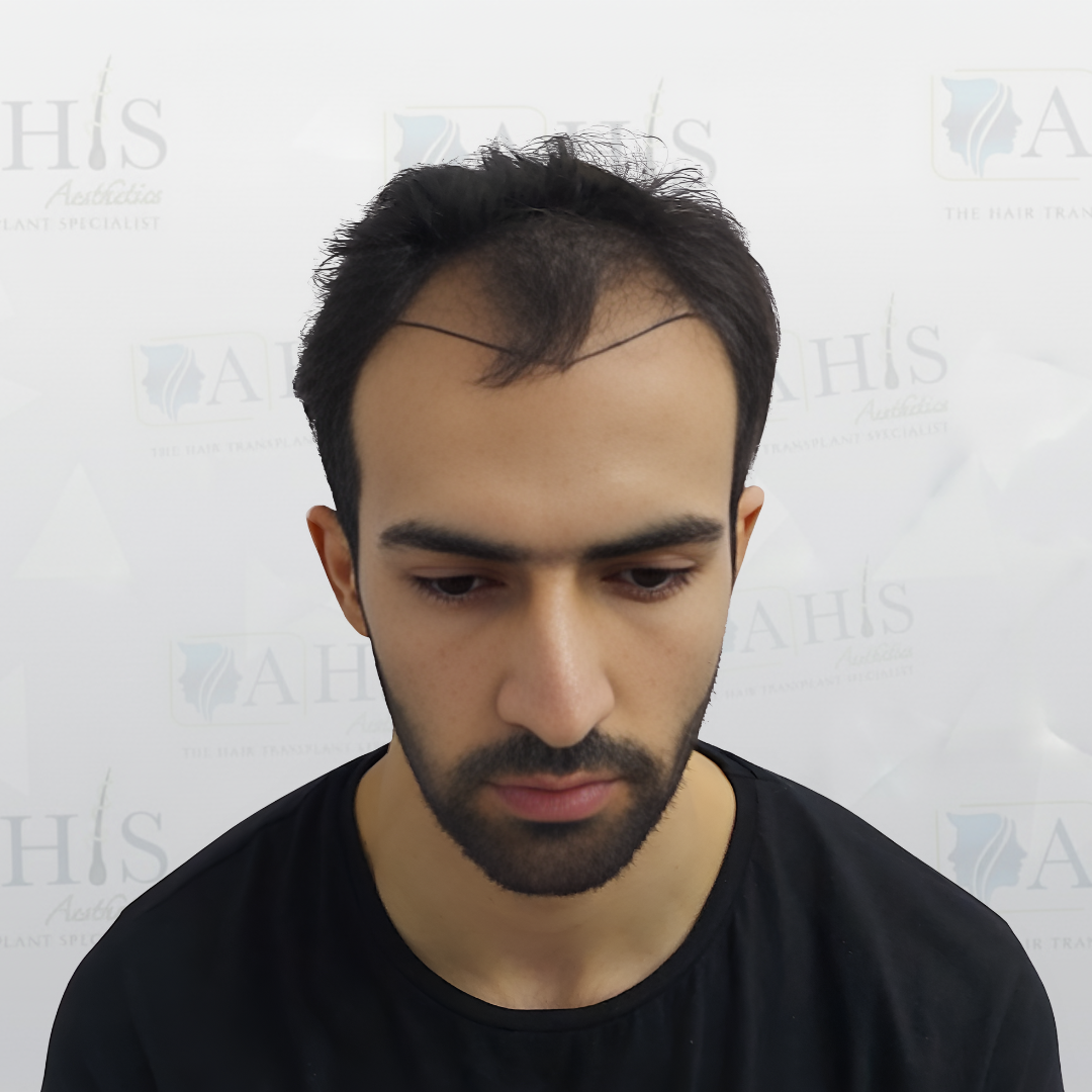 Hairline & Frontal Density Restoration — before hair transplant at AHIS Aesthetics Mysore