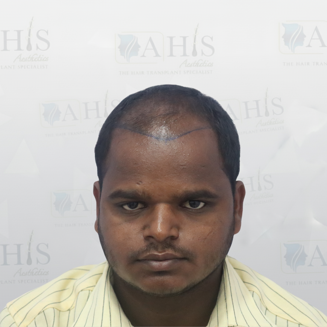 Advanced Frontal Hair Restoration — before hair transplant at AHIS Aesthetics Mysore