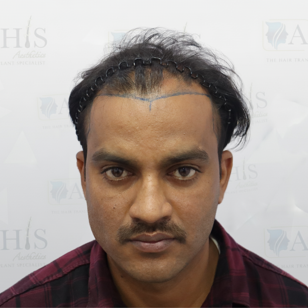 Hairline Reconstruction & Density — before hair transplant at AHIS Aesthetics Mysore